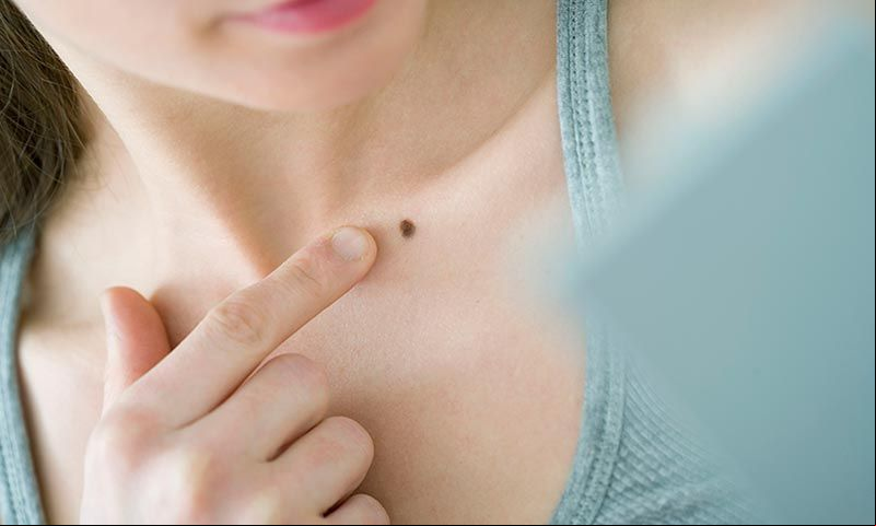 este lunar es melanoma 1