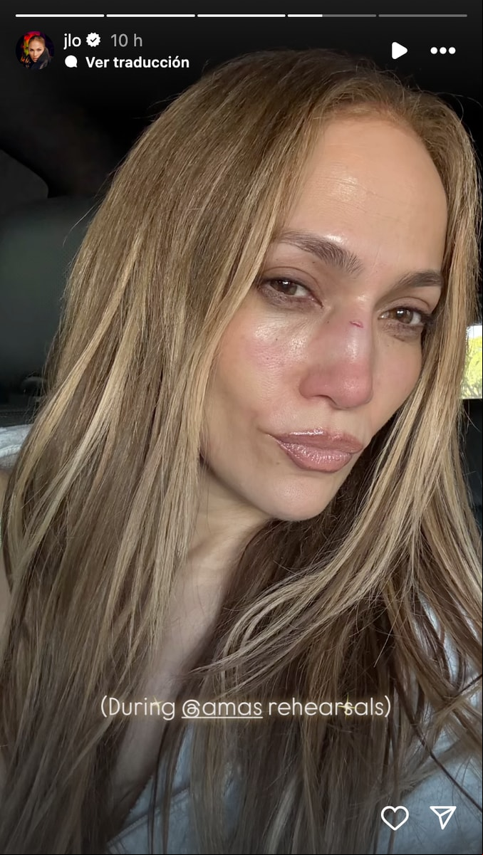 Jennifer Lopez gets stitches after bloody AMAs rehearsal